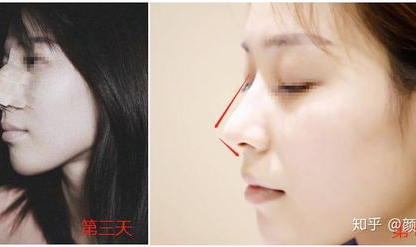 哪里整形鼻子好,揭秘哪家医院整形鼻子更胜一筹”