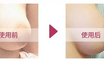 乳房整形手术,乳房整形手术全解析