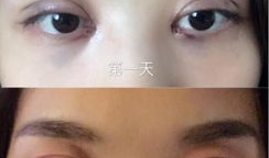 埋线双眼皮整形医院,专业埋线整形医院为您量身定制美丽蜕变之旅
